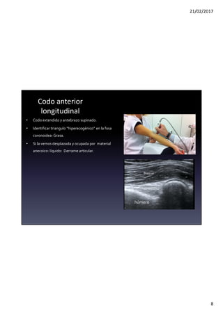21/02/2017
8
Codo anterior
longitudinal
• Codo extendido y antebrazo supinado.
• Identificar triangulo “hiperecogénico” en la fosa
coronoidea: Grasa.
• Si la vemos desplazada y ocupada por material
anecoico: líquido: Derrame articular.
Braquial
húmero
Fosa coronoidea
 