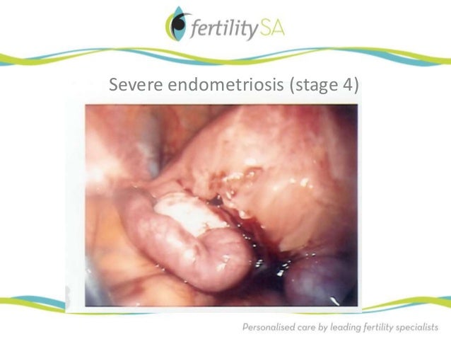 Endometriosis Stage 4 Diet