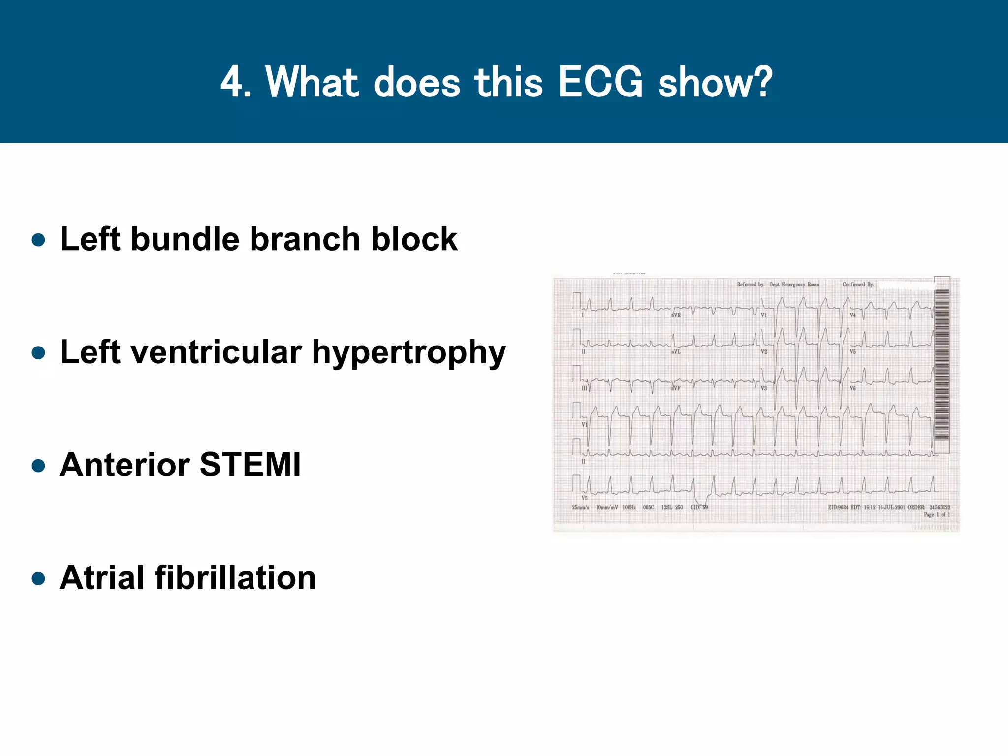 4. What does this ECG show?
 Left bundle branch block
 Left ventricular hypertrophy
 Anterior STEMI
 Atrial fibrillation
 