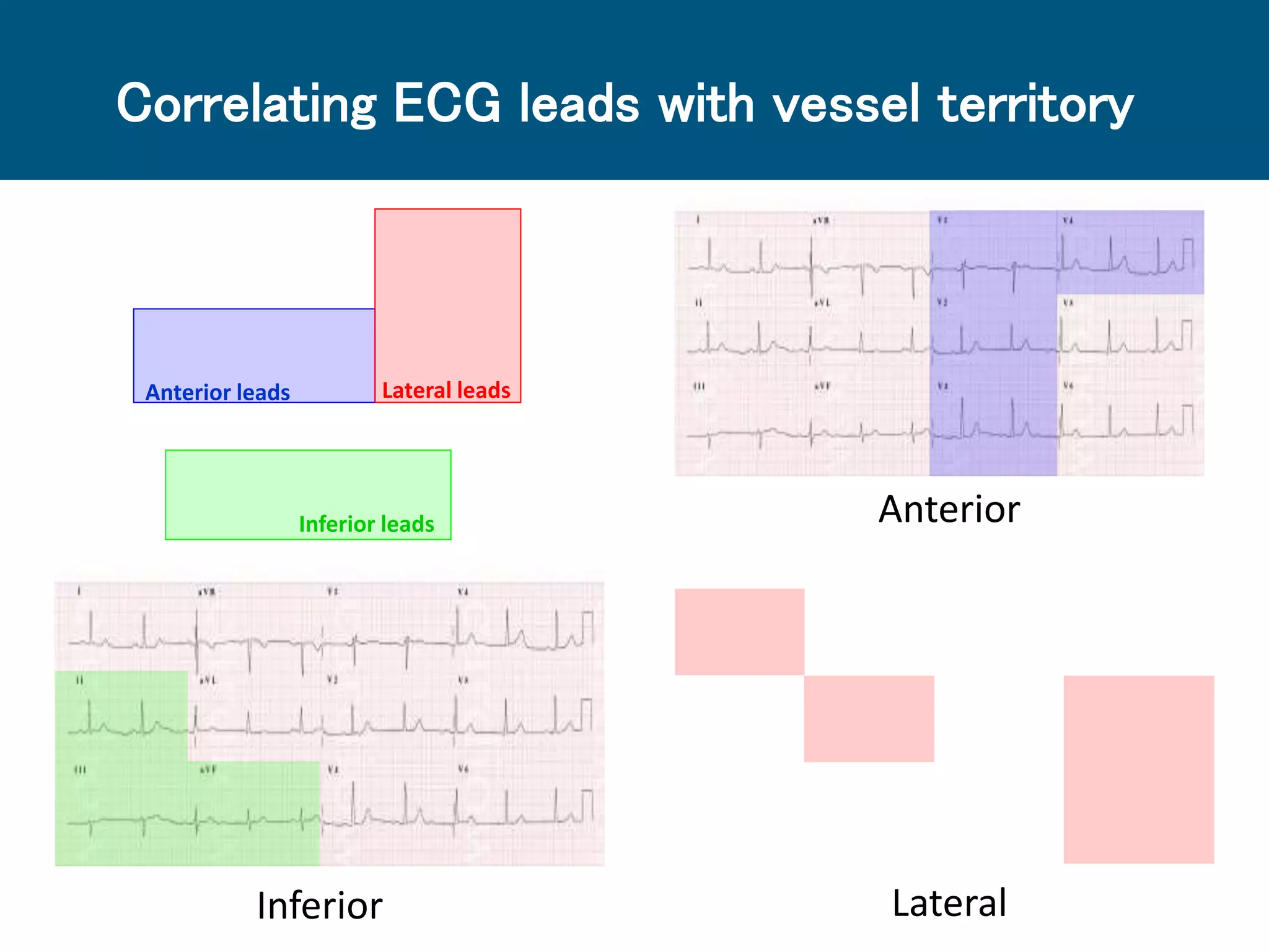 Correlating ECG leads with vessel territory
Inferior Lateral
AnteriorInferior leads
Anterior leads Lateral leads
 