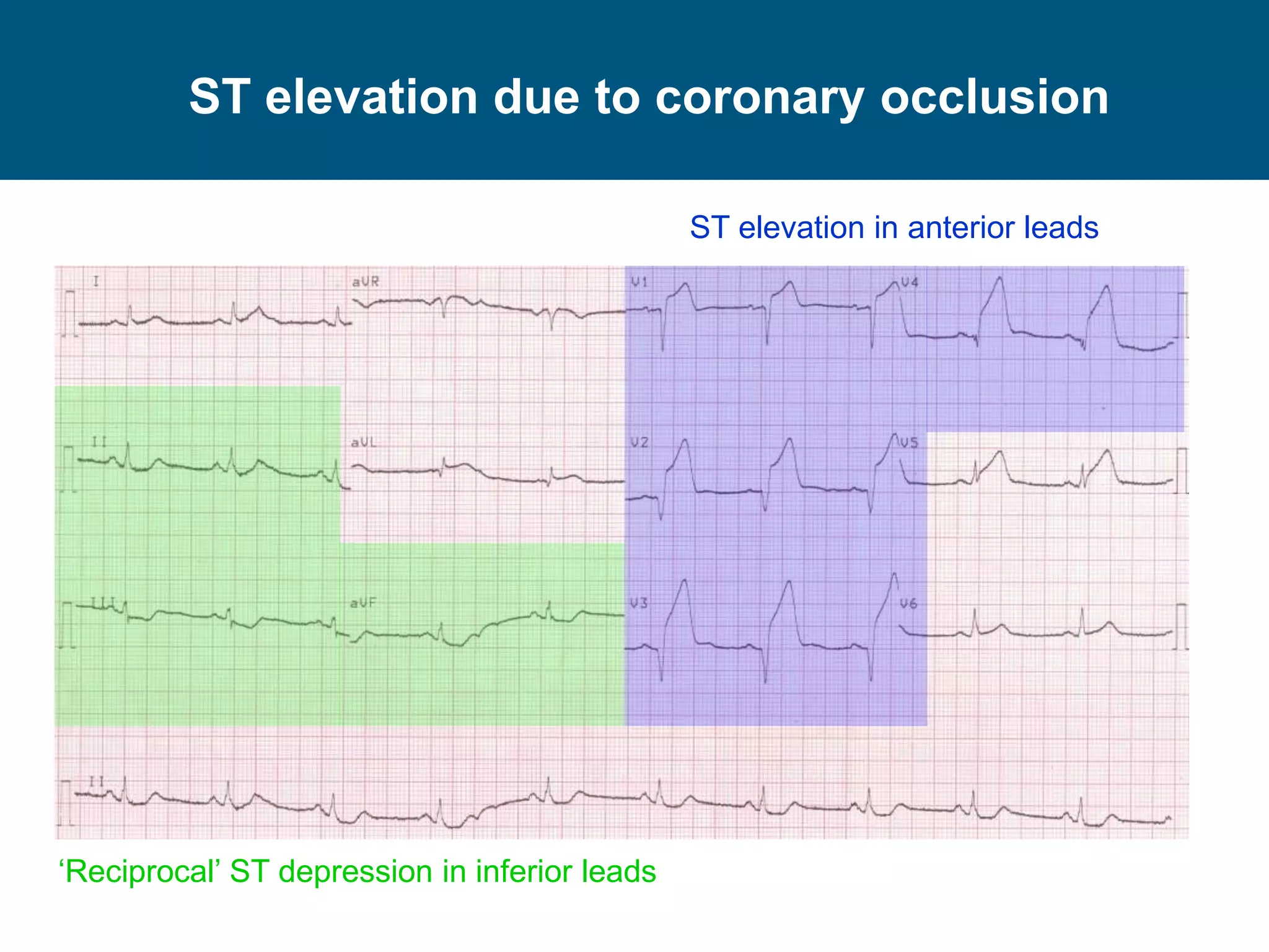 ST elevation due to coronary occlusion
ST elevation in anterior leads
‘Reciprocal’ ST depression in inferior leads
 