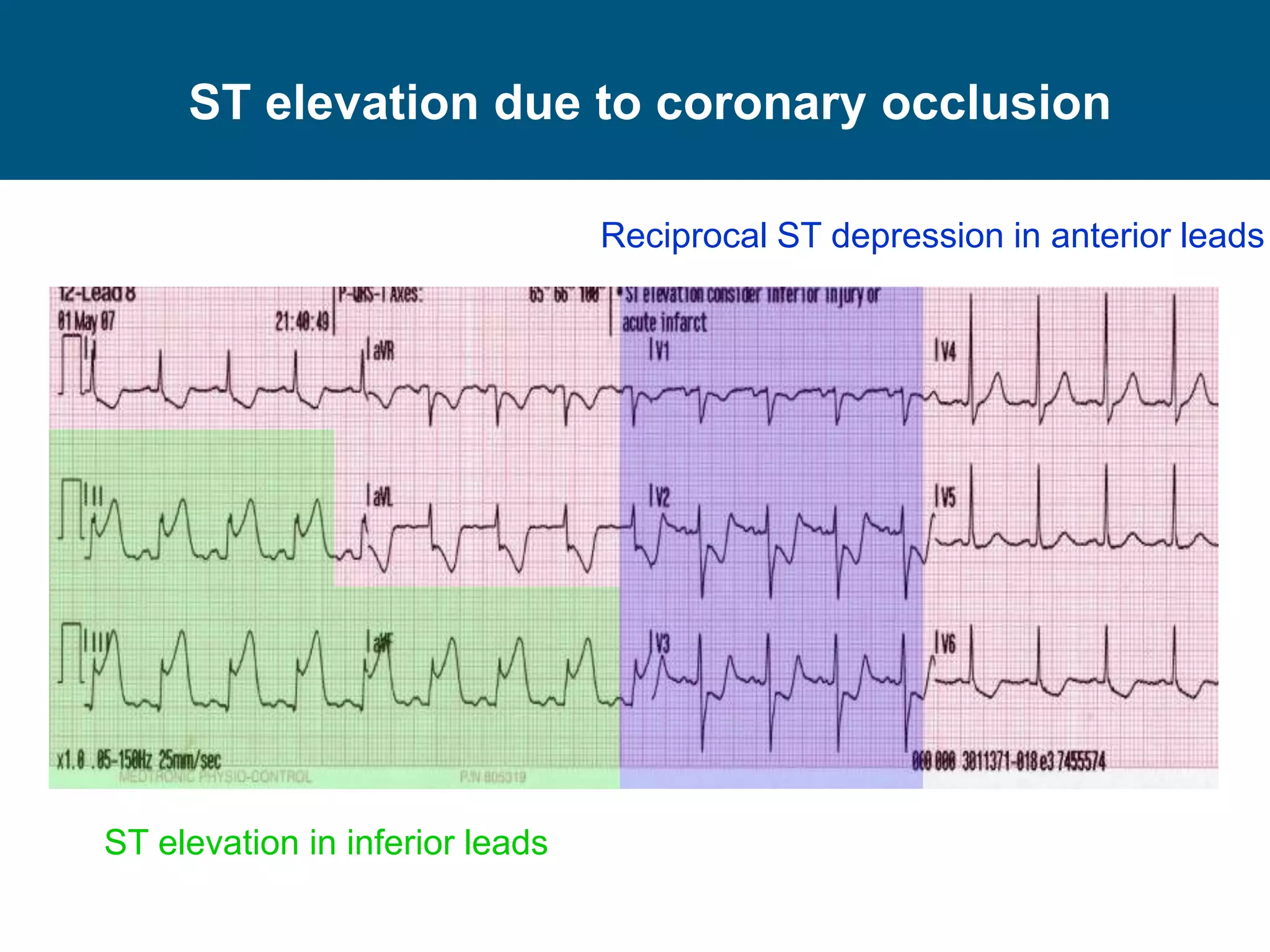 ST elevation in inferior leads
Reciprocal ST depression in anterior leads
ST elevation due to coronary occlusion
 