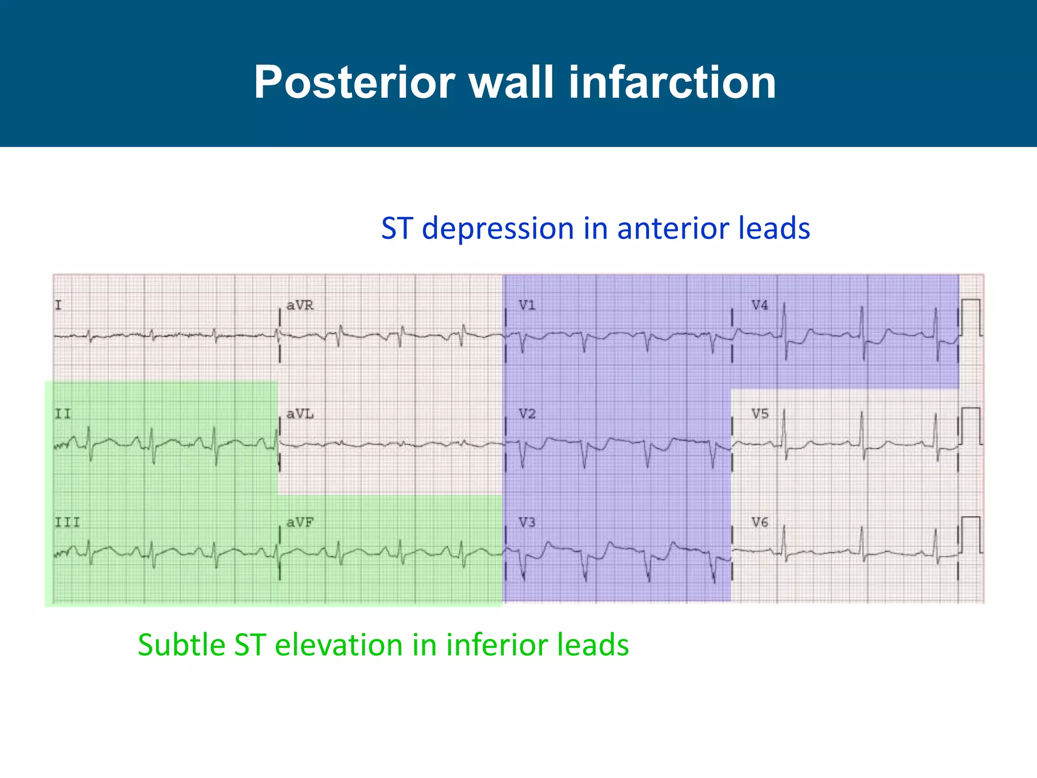 Posterior wall infarction
ST depression in anterior leads
Subtle ST elevation in inferior leads
 
