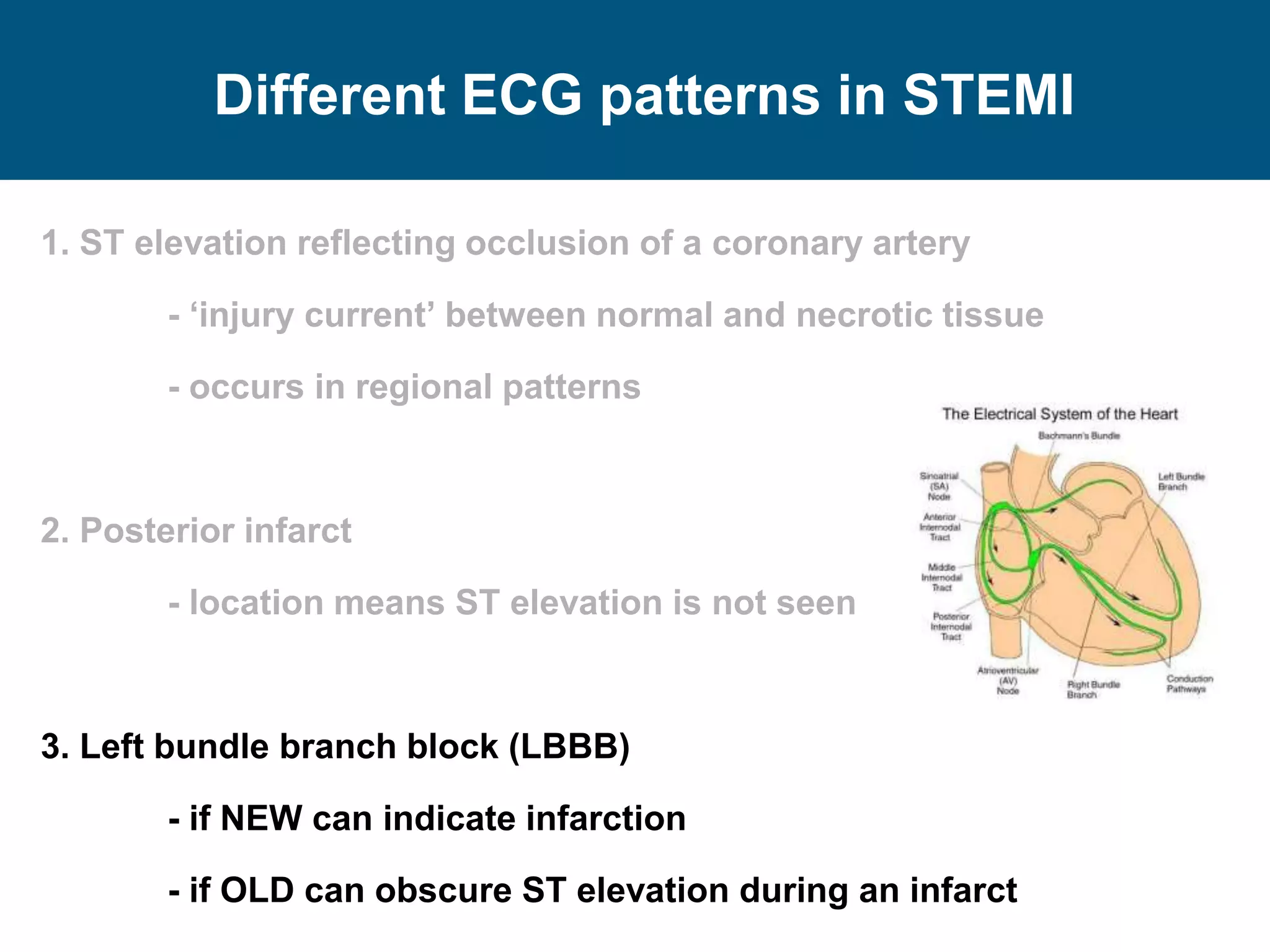 Different ECG patterns in STEMI
1. ST elevation reflecting occlusion of a coronary artery
- ‘injury current’ between normal and necrotic tissue
- occurs in regional patterns
2. Posterior infarct
- location means ST elevation is not seen
3. Left bundle branch block (LBBB)
- if NEW can indicate infarction
- if OLD can obscure ST elevation during an infarct
 