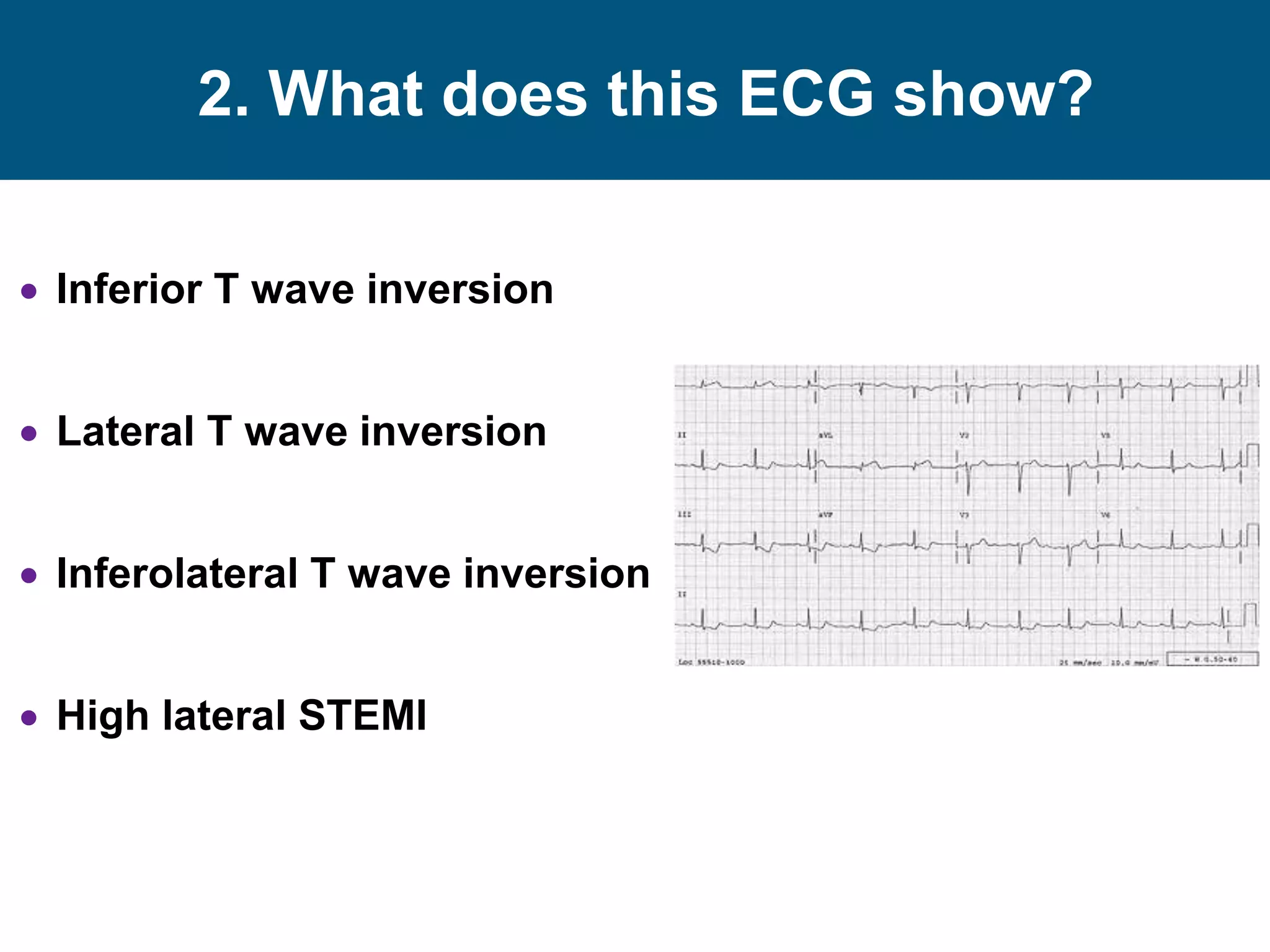 2. What does this ECG show?
 Inferior T wave inversion
 Lateral T wave inversion
 Inferolateral T wave inversion
 High lateral STEMI
 