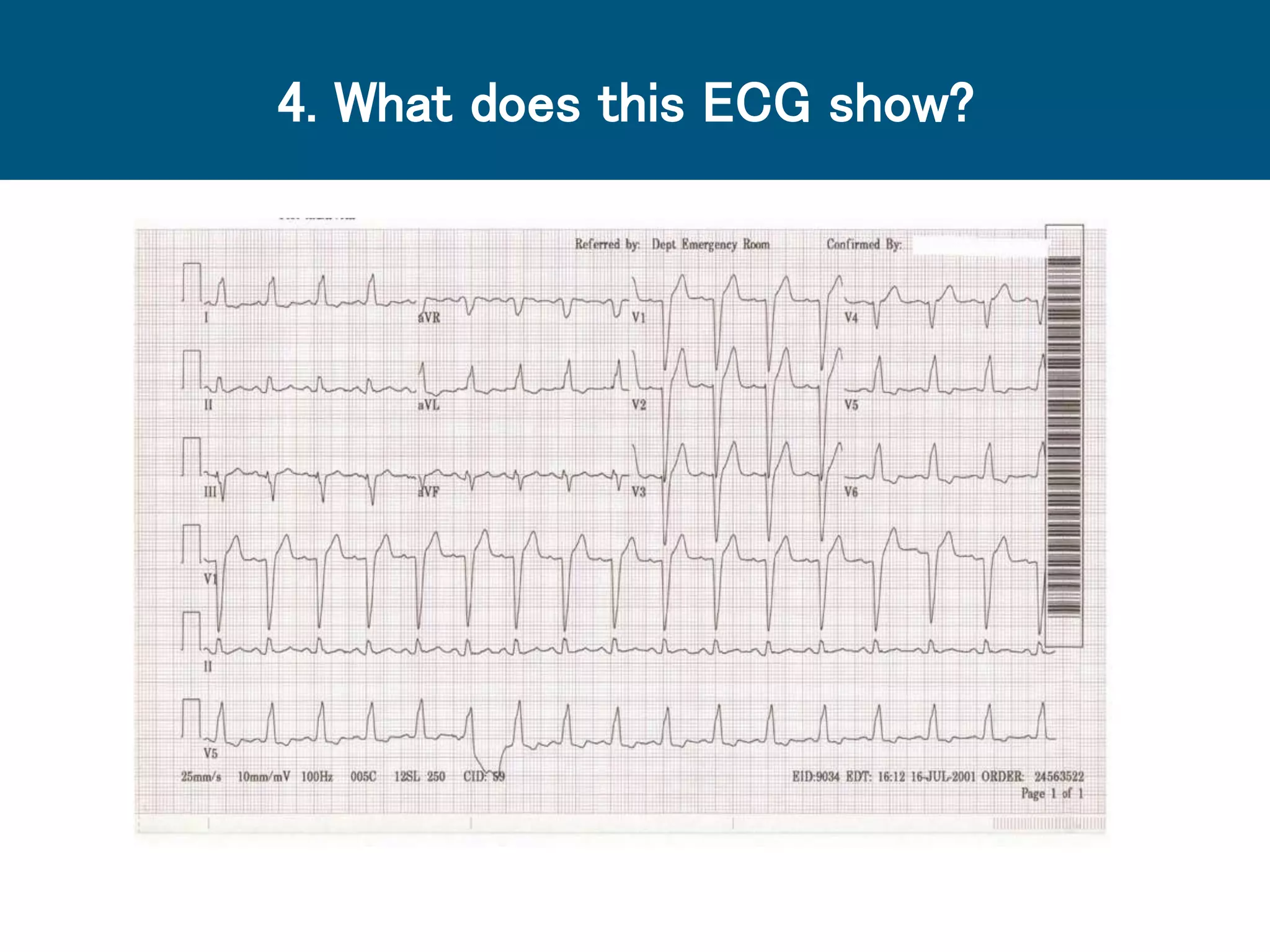 4. What does this ECG show?
 