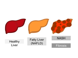 Healthy
Liver
Fatty Liver
(NAFLD)
NASH
Fibrosis
 