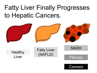 Healthy
Liver
Fatty Liver
(NAFLD)
NASH
Fibrosis
Cancers
Fatty Liver Finally Progresses
to Hepatic Cancers.
 