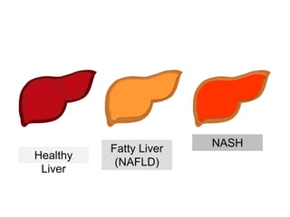Healthy
Liver
Fatty Liver
(NAFLD)
NASH
 
