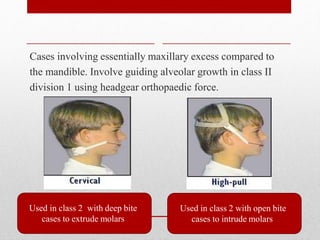 Cases involving essentially maxillary excess compared to
the mandible. Involve guiding alveolar growth in class II
division 1 using headgear orthopaedic force.
Used in class 2 with open bite
cases to intrude molars
Used in class 2 with deep bite
cases to extrude molars
 