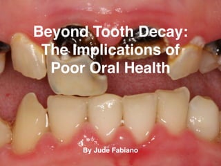 Beyond Tooth Decay:
The Implications of
Poor Oral Health
By Jude Fabiano
 