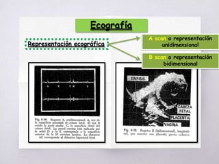 Ecografía
Representación ecográfica
A scan o representación
unidimensional
B scan o representación
bidimensional
 