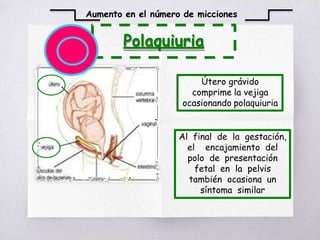 Polaquiuria
Aumento en el número de micciones
Útero grávido
comprime la vejiga
ocasionando polaquiuria
Al final de la gestación,
el encajamiento del
polo de presentación
fetal en la pelvis
también ocasiona un
síntoma similar
 