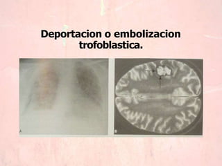 Deportacion o embolizacion
trofoblastica.
 