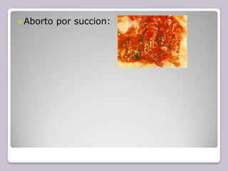 ⚫Aborto por succion:
 
