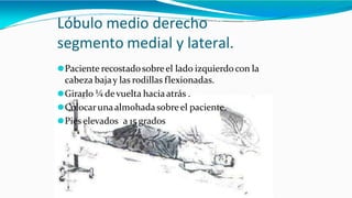 Lóbulo medio derecho
segmento medial y lateral.
⚫Paciente recostadosobreel lado izquierdo con la
cabeza bajay las rodillas flexionadas.
⚫Girarlo ¼ devuelta haciaatrás .
⚫Colocarunaalmohadasobreel paciente.
⚫Pies elevados a 15 grados
 