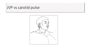 JVP vs carotid pulse
 