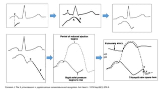 Constant J. The X prime descent in jugular contour nomenclature and recognition. Am Heart J. 1974 Sep;88(3):372-9.
 