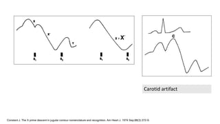 Carotid artifact
Constant J. The X prime descent in jugular contour nomenclature and recognition. Am Heart J. 1974 Sep;88(3):372-9.
 