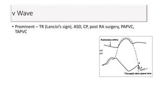 v Wave
• Prominent – TR (Lancisi’s sign), ASD, CP, post RA surgery, PAPVC,
TAPVC
 