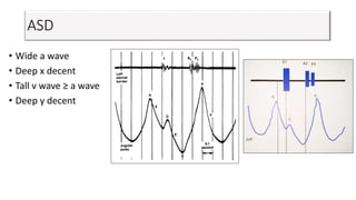 ASD
• Wide a wave
• Deep x decent
• Tall v wave ≥ a wave
• Deep y decent
 