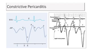 Constrictive Pericarditis
 