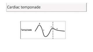 Cardiac temponade
 