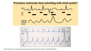 Chua Chiaco JM, et al. The jugular venous pressure revisited. Cleve Clin J Med. 2013 Oct;80(10):638-44.
 