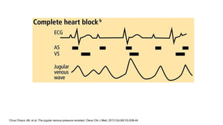 Chua Chiaco JM, et al. The jugular venous pressure revisited. Cleve Clin J Med. 2013 Oct;80(10):638-44.
 