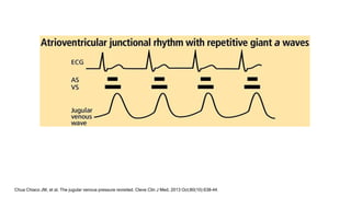 Chua Chiaco JM, et al. The jugular venous pressure revisited. Cleve Clin J Med. 2013 Oct;80(10):638-44.
 