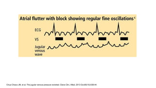 Chua Chiaco JM, et al. The jugular venous pressure revisited. Cleve Clin J Med. 2013 Oct;80(10):638-44.
 