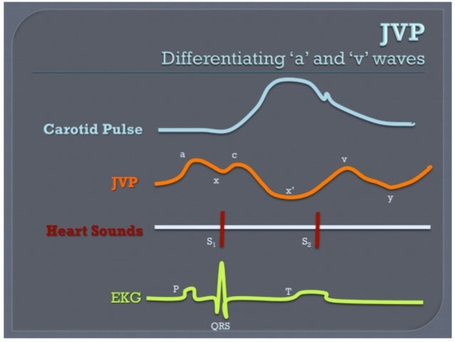 Jugular Venous Pressure Waveform