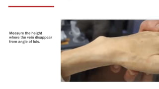 Measure the height
where the vein disappear
from angle of luis.
 