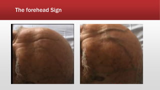 The forehead Sign
 