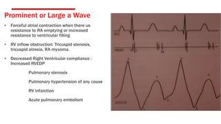 Prominent or Large a Wave
• Forceful atrial contraction when there us
resistance to RA emptying or increased
resistance to ventricular filling
• RV inflow obstruction: Tricuspid stenosis,
tricuspid atresia, RA myxoma.
• Decreased Right Ventricular compliance :
Increased RVEDP
Pulmonary stenosis
Pulmonary hypertension of any cause
RV infarction
Acute pulmonary embolism
 