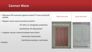 Cannon Wave
▪ Whenever RA contracts against closed TV valve during RV
systole.
▪ Regular canon waves-Junctional rhythm
-VT with 1:1 retrograde conduction
-Isorhythmic AV dissociation
▪ Irregular cannon waves-Complete heart block
-Ventricular tachycardia
-Ventricular pacing or ventricular
ectopics.
 