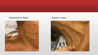 Prominent a wave Canon a wave
 