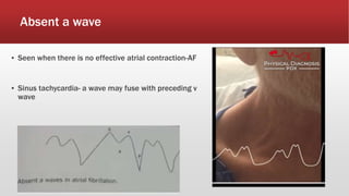 Absent a wave
▪ Seen when there is no effective atrial contraction-AF
▪ Sinus tachycardia- a wave may fuse with preceding v
wave
 