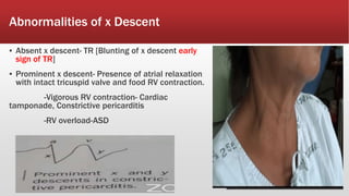 Abnormalities of x Descent
▪ Absent x descent- TR [Blunting of x descent early
sign of TR]
▪ Prominent x descent- Presence of atrial relaxation
with intact tricuspid valve and food RV contraction.
-Vigorous RV contraction- Cardiac
tamponade, Constrictive pericarditis
-RV overload-ASD
 