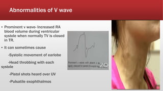 Abnormalities of V wave
▪ Prominent v wave- Increased RA
blood volume during ventricular
systole when normally TV is closed
in TR.
▪ It can sometimes cause
-Systolic movement of earlobe
-Head throbbing with each
systole
-Pistol shots heard over IJV
-Pulsatile exophthalmos
 