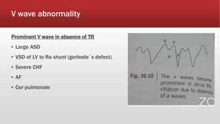 V wave abnormality
Prominent V wave in absence of TR
▪ Large ASD
▪ VSD of LV to Ra shunt (gerbode`s defect)
▪ Severe CHF
▪ AF
▪ Cor pulmonale
 