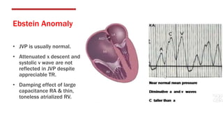 Ebstein Anomaly
• JVP is usually normal.
• Attenuated x descent and
systolic v wave are not
reflected in JVP despite
appreciable TR.
• Damping effect of large
capacitance RA & thin,
toneless atrialized RV.
 