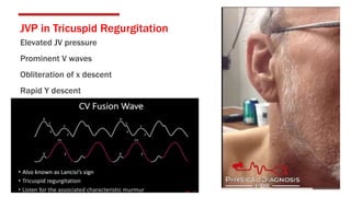 JVP in Tricuspid Regurgitation
Elevated JV pressure
Prominent V waves
Obliteration of x descent
Rapid Y descent
 