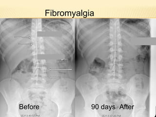 Before 90 days After
Fibromyalgia
 