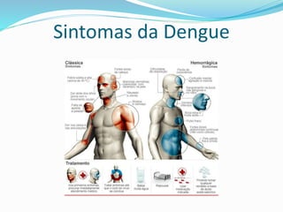 Sintomas da Dengue
 