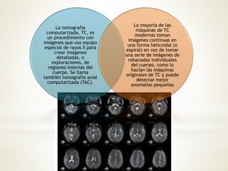 La tomografía
computarizada, TC, es
un procedimiento con
imágenes que usa equipo
especial de rayos X para
crear imágenes
detalladas, o
exploraciones, de
regiones internas del
cuerpo. Se llama
también tomografía axial
computarizada (TAC).
La mayoría de las
máquinas de TC
modernas toman
imágenes continuas en
una forma helicoidal (o
espiral) en vez de tomar
una serie de imágenes de
rebanadas individuales
del cuerpo, como lo
hacían las máquinas
originales de TC y puede
detectar mejor
anomalías pequeñas
 