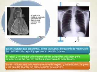 Los rayos X se producen
siempre que se bombardea
un objeto material con
electrones de alta
velocidad. Gran parte de la
energía de los electrones se
pierde en forma de calor; el
resto produce rayos X al
provocar cambios en los
átomos del blanco como
resultado del impacto.
Las estructuras que son densas, como los huesos, bloquearán la mayoría de
las partículas de rayos X y aparecerán de color blanco.
El metal y los medios de contraste (tintes especiales utilizados para
resaltar áreas del cuerpo) también aparecerán de color blanco.
Las estructuras que contienen aire se verán negras, y los músculos, la grasa
y los líquidos aparecerán como sombras de color gris.
 