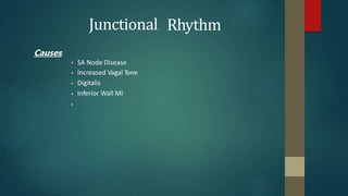 Causes:
Junctional Rhythm
•
•
•
•
•
SA Node Disease
Increased Vagal Tone
Digitalis
Inferior Wall MI
 