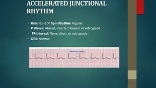 ACCELERATED JUNCTIONAL
RHYTHM
•
•
•
•
Rate: 61–100 bpm Rhythm: Regular
P Waves: Absent, inverted, buried, or retrograde
PR Interval: None, short, or retrograde
QRS: Normal
 