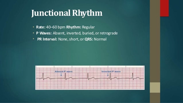Treatment For Junctional Rhythm Page 3 Line 17qq Com